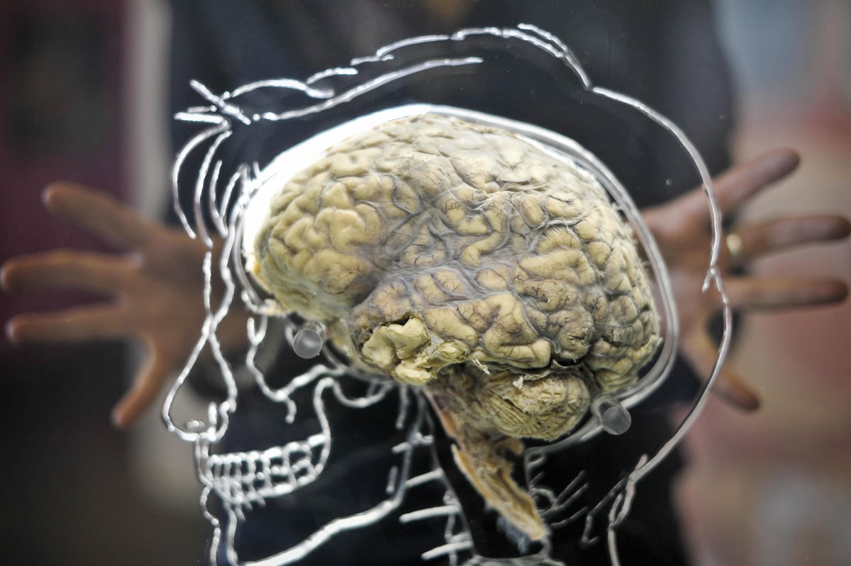 New insight into protein production in brain could help tackle dementia – study