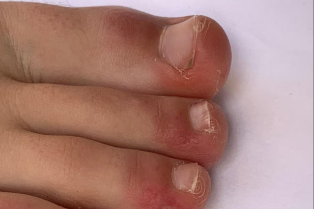 What is Covid Toe? Scientists reveal reason behind condition