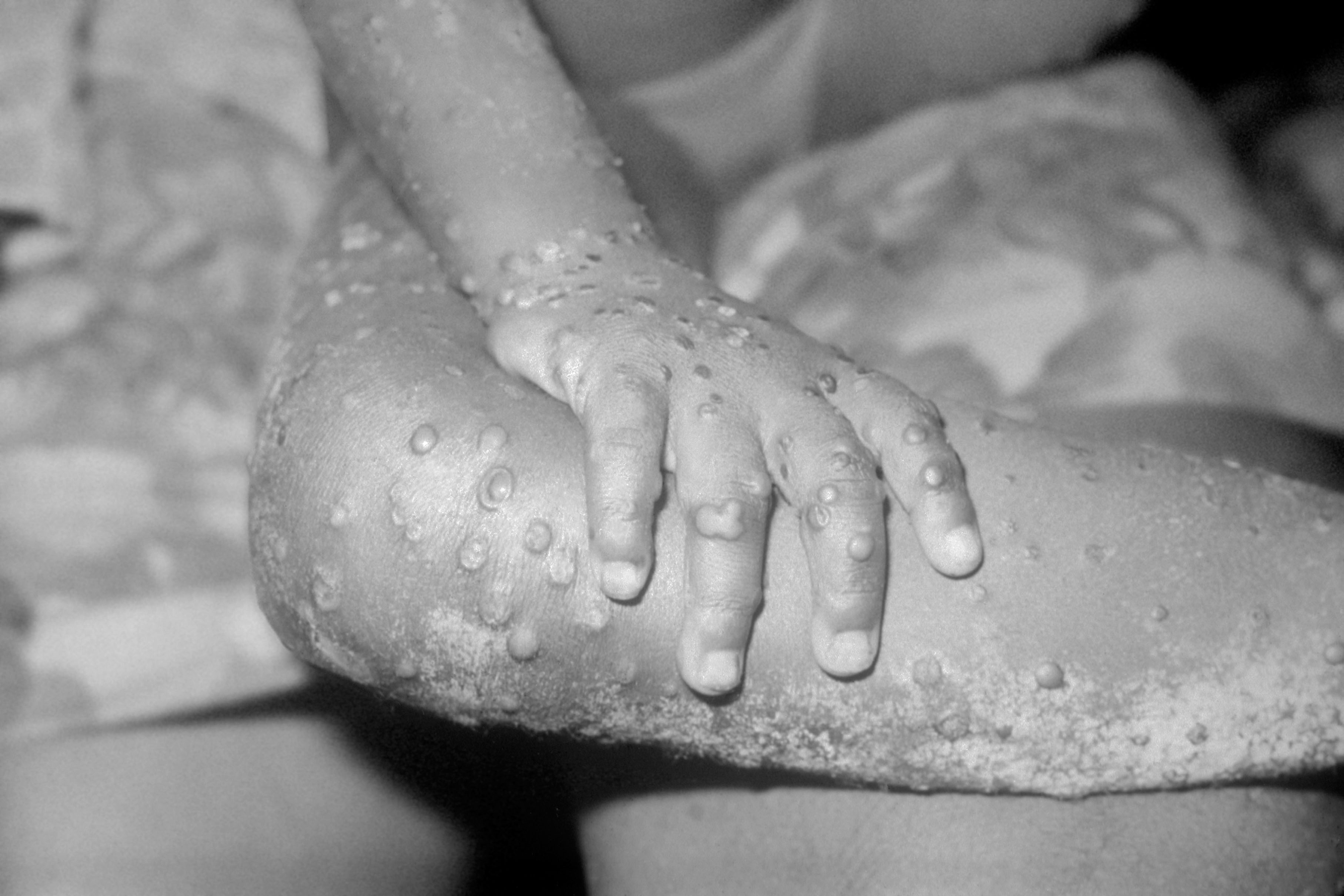 Monkeypox: 20 cases now confirmed in the UK