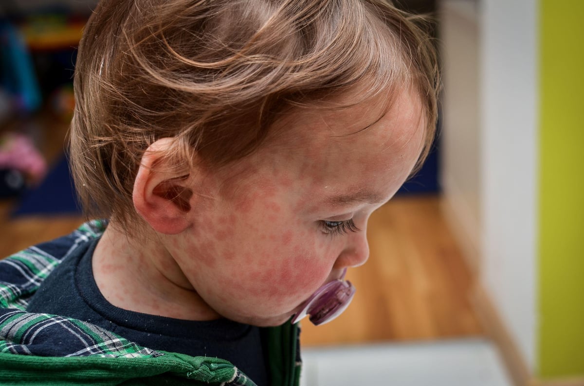 Vaccine plea as measles cases rise significantly in London