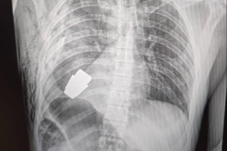 Ukrainian doctors remove unexploded grenade from soldier’s chest with ground-breaking surgery