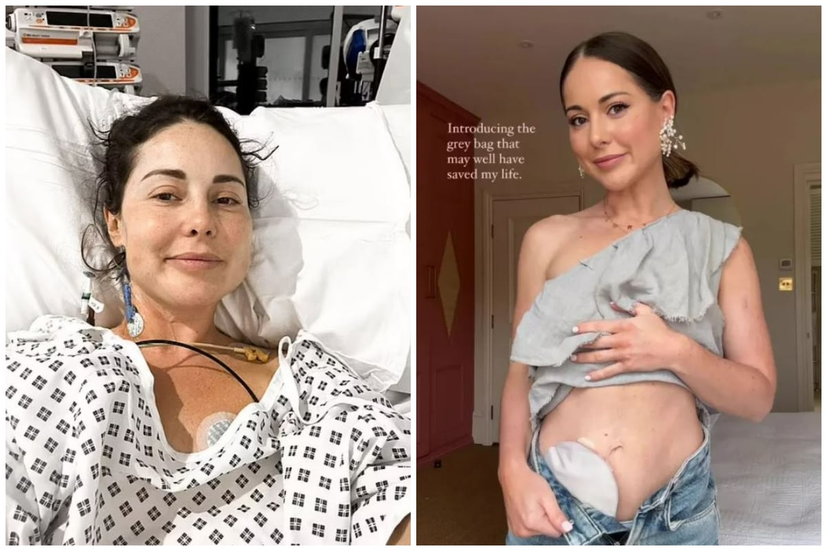 What is a stoma bag? Louise Thompson opens up about ulcerative colitis