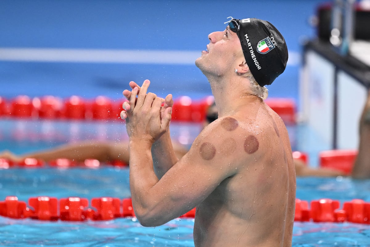 What is cupping and why do olympians have red circles on their skin? 