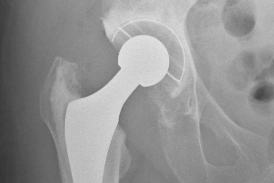 Hip replacement firm Smith & Nephew’s profit surges amid recovery in US sales