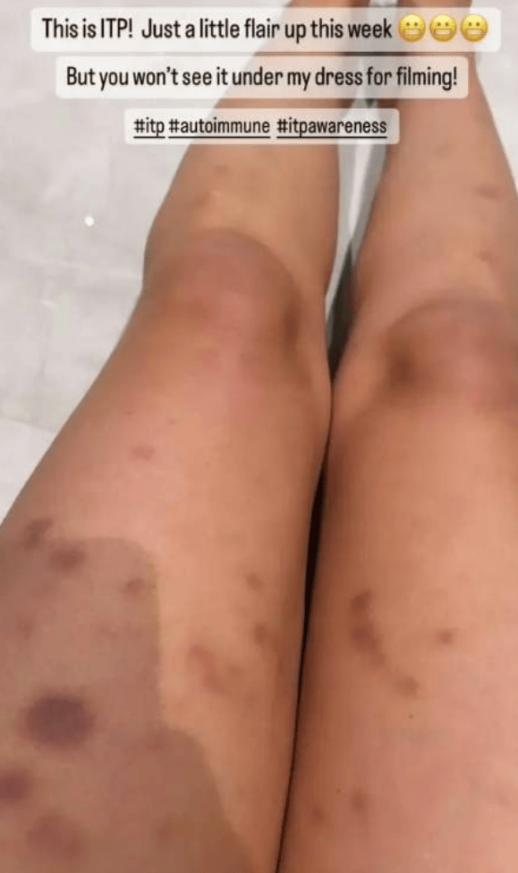 Laura Hamilton health condition