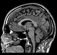 Drugs hope to repair MS damage | London Evening Standard