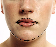 Cosmetic surgeons offer 'feel-good packages' for newly divorced women | London Evening Standard