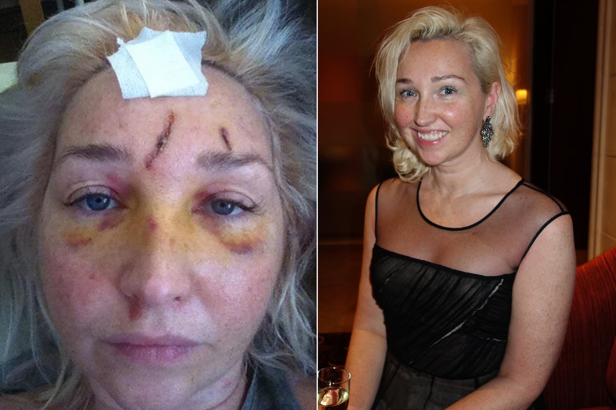 Woman scarred for life after cyclist knocked her over, then 'grinned before speeding off' | London Evening Standard