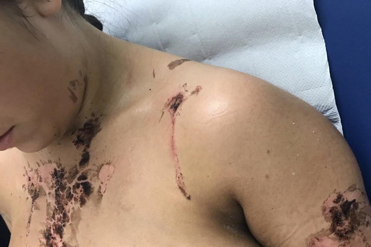 Arthur Collins acid attack: Victims reveal horrific injuries as they call for tougher sentences for offenders | London Evening Standard