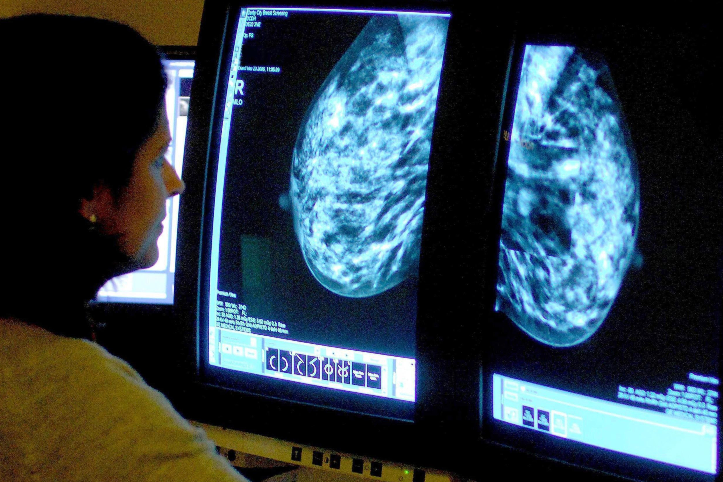 Breast cancer becomes ‘most common cancer in the world’ with 2.3 million cases diagnosed in 2020