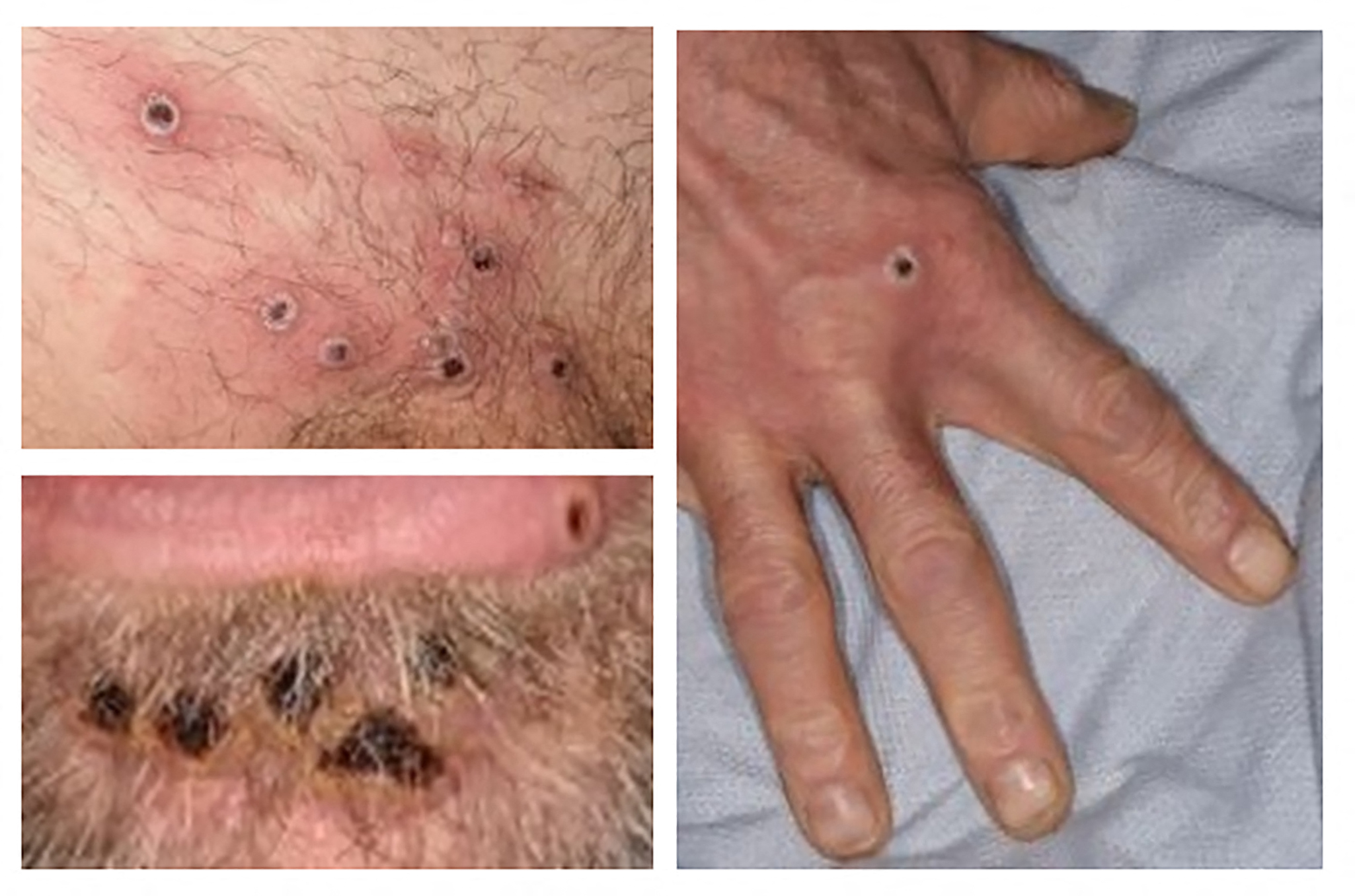 FILES-DENMARK-HEALTH-VIRUS-VACCINE