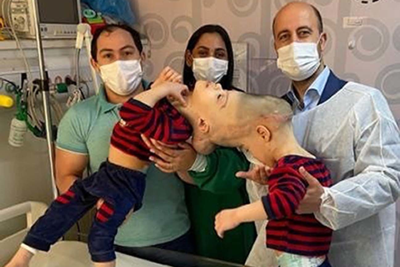 Conjoined twins separated