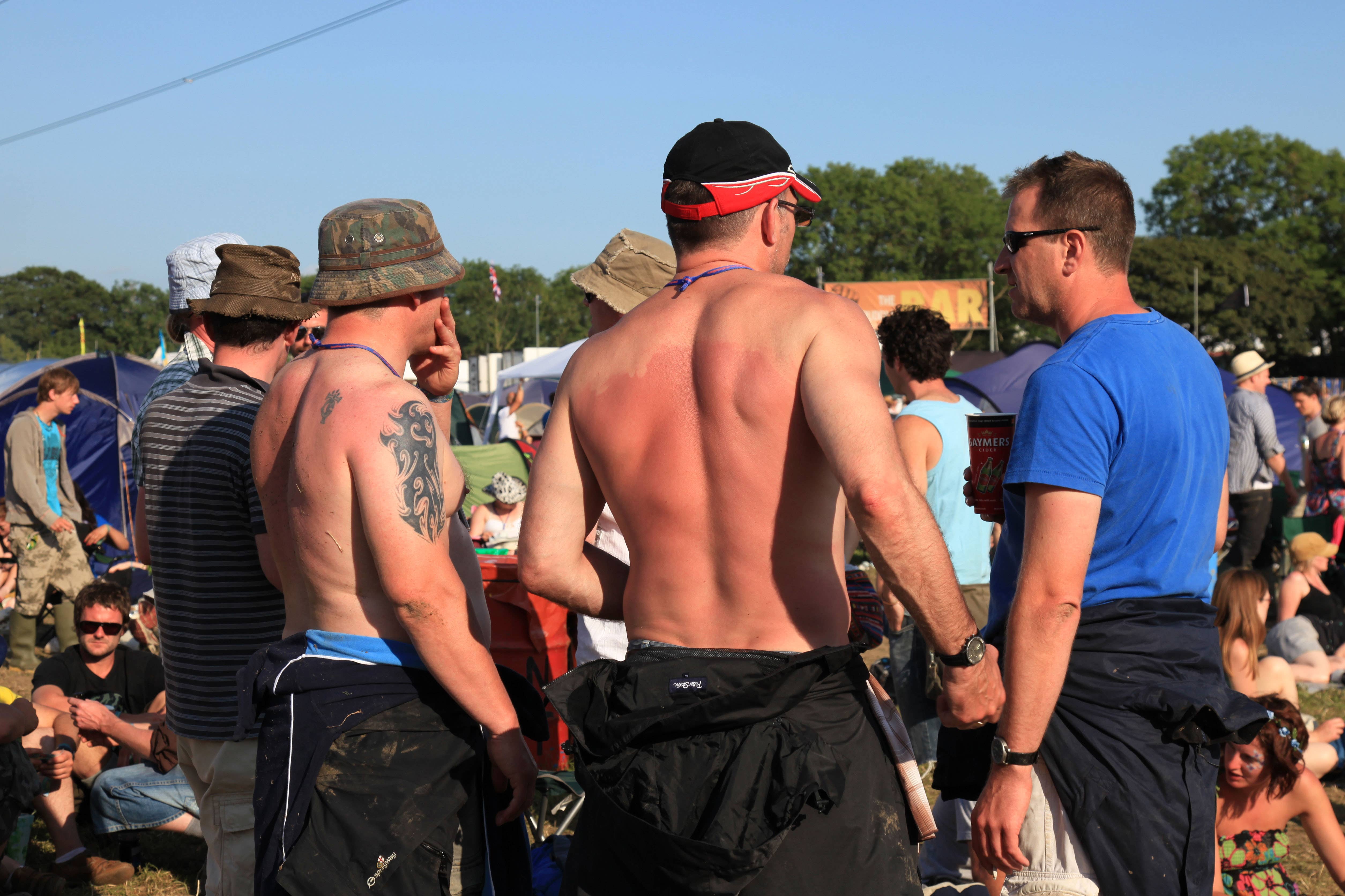 Sunburnt man with no top on from the back