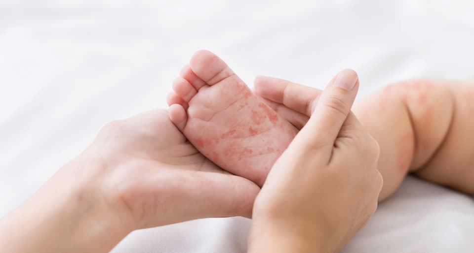 The spots of the measles rash, which are not usually itchy, are sometimes raised and join together to form blotchy patches (Alamy/PA)