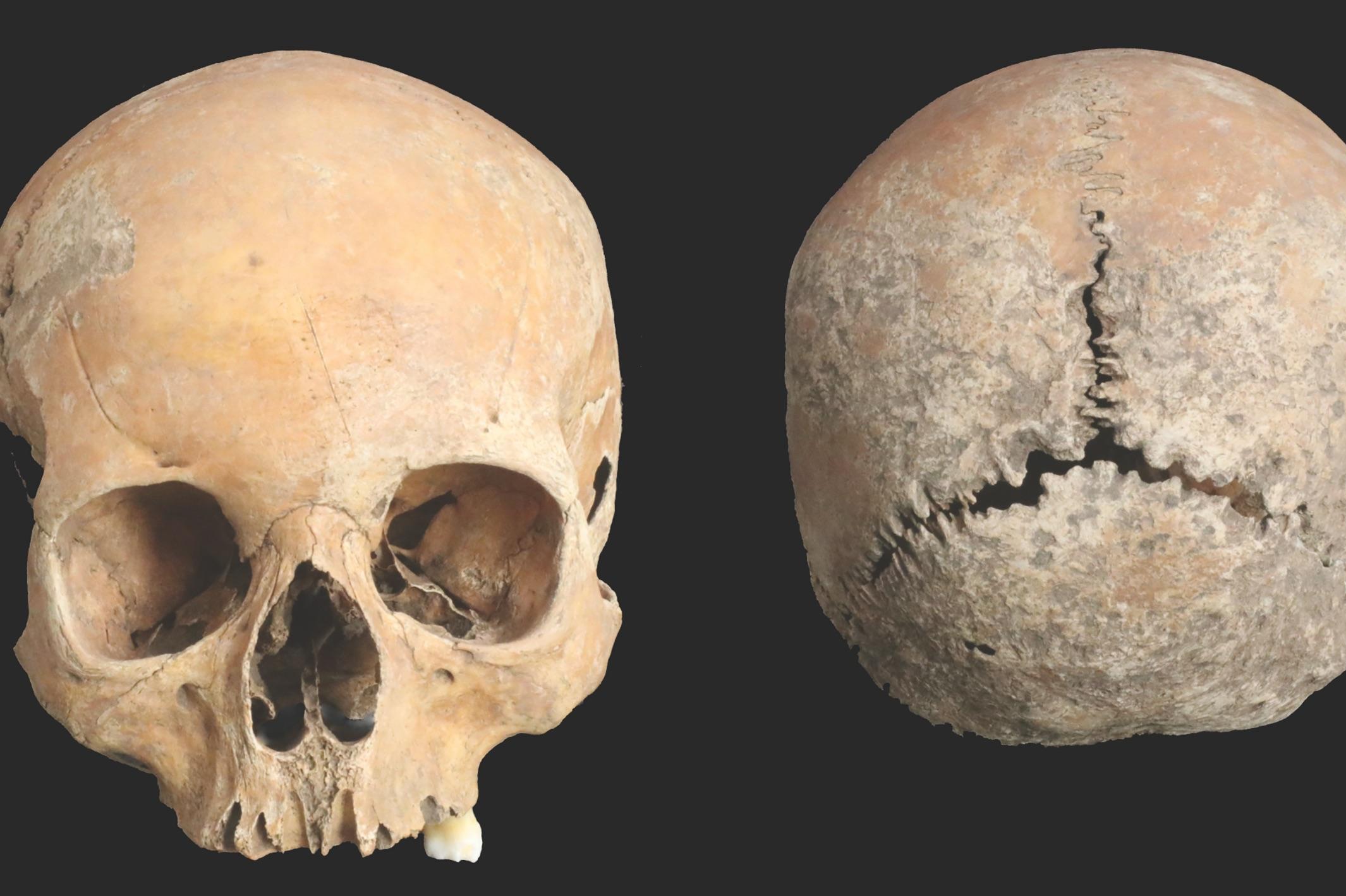 Anglo-Saxon girl 'had nose and lips cut off as adultery punishment'